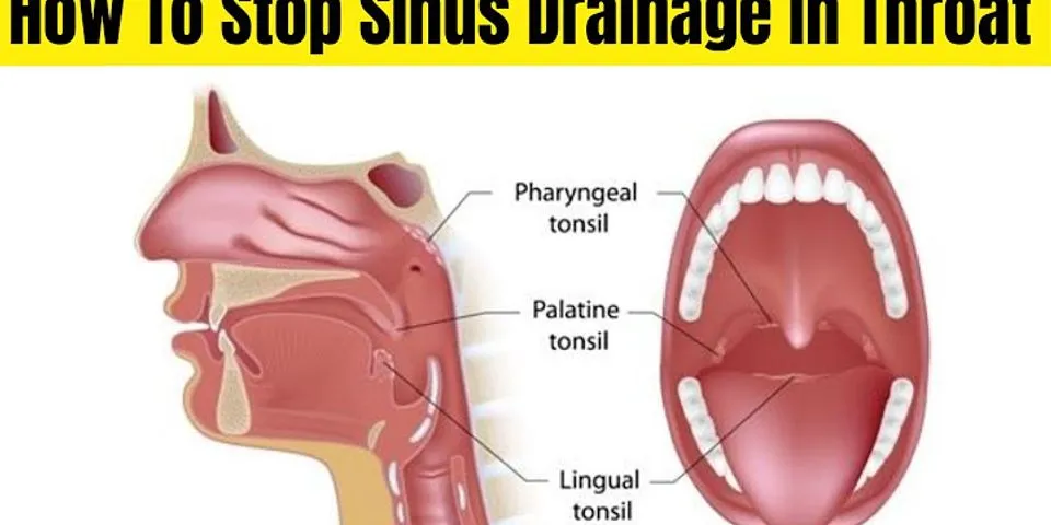 How do I stop coughing from sinus drainage